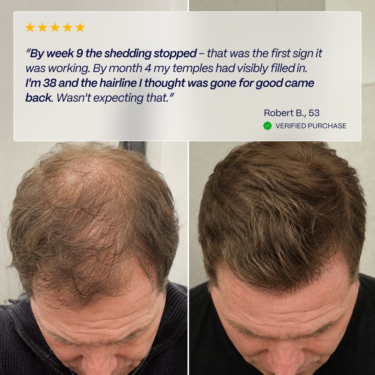 Hairmidine | Multi-Pathway Hair Growth Support Formula