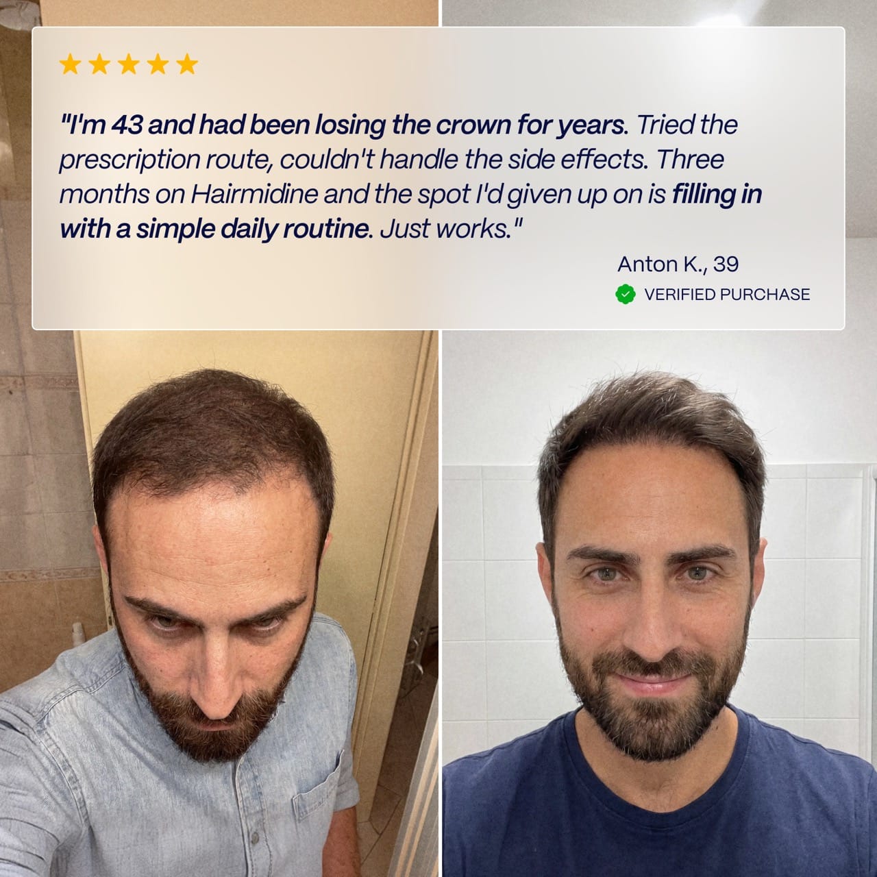 Hairmidine | Multi-Pathway Hair Growth Support Formula